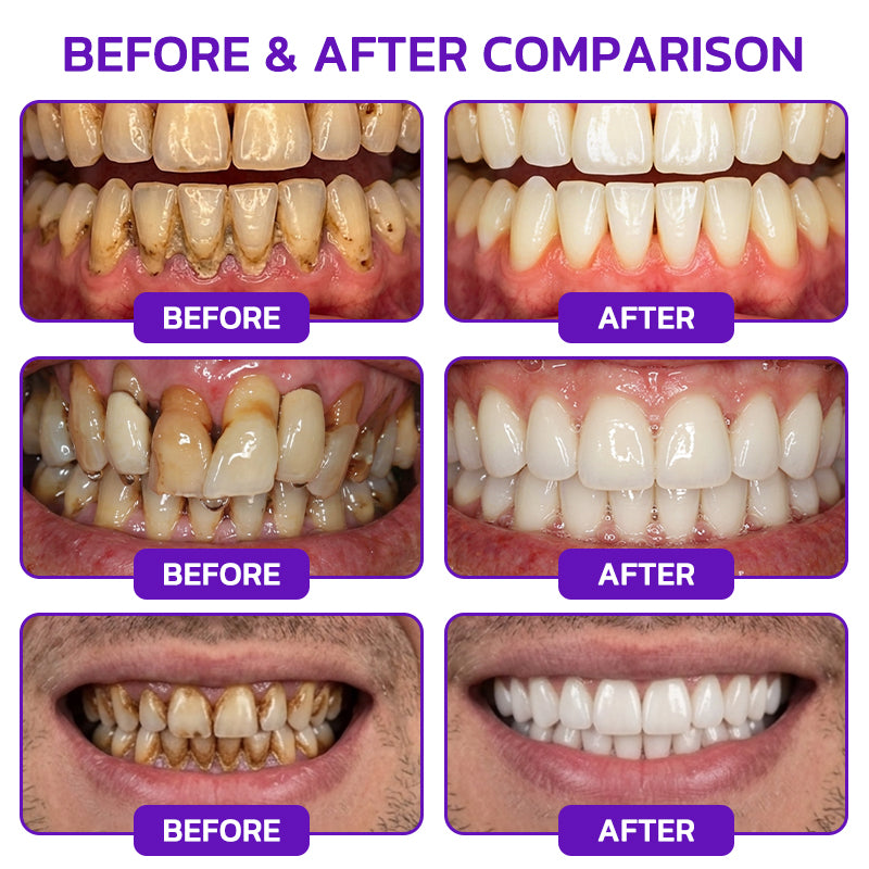 🇬🇧🧑‍⚕️🦷Evolvion® Bee Venom Gingivitis & Periodontitis Treatment Toothpaste🎁