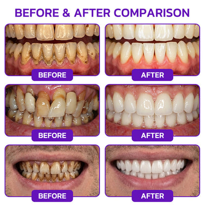 🇬🇧🧑‍⚕️🦷Evolvion® Bee Venom Gingivitis & Periodontitis Treatment Toothpaste🎁