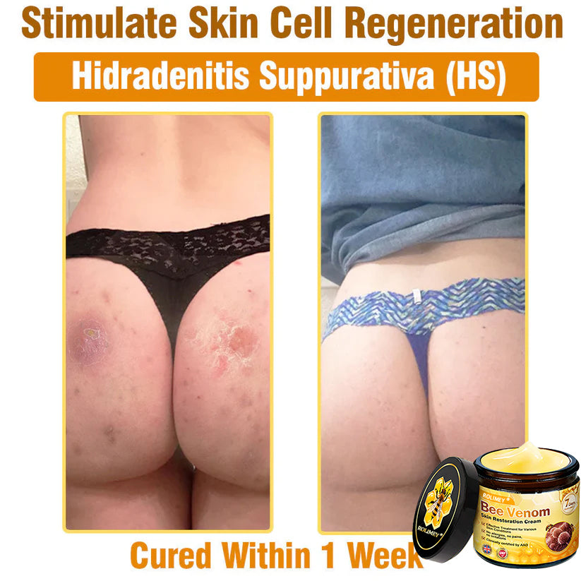 🥇FDA Approved: Rolimey® Bee Venom Skin Restoration Cream — 🔥Limited Time 80% OFF🔥