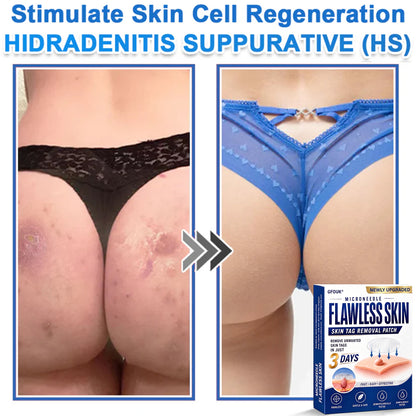 🔥GFOUK® 2026 Newly Upgraded 2-in-1 Microneedle Hydrocolloid Patches | Removes Raised Moles, Acne, Flat Warts, and Skin Tags | Improves Wrinkles, Scars, and Blemishes | Invisible Acne Patches for Face & Body