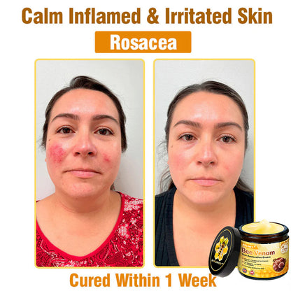 🥇FDA Approved: Rolimey® Bee Venom Skin Restoration Cream — 🔥Limited Time 80% OFF🔥