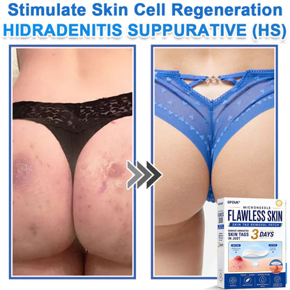 ✨GFOUK® 2026 Newly Upgraded 2-in-1 Microneedle Hydrocolloid Patches | Removes Raised Moles, Acne, Flat Warts, and Skin Tags | Improves Wrinkles, Scars, and Blemishes | Invisible Acne Patches for Face & Body