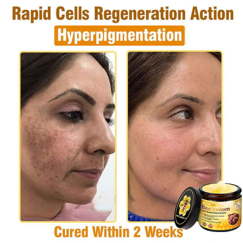 🥇FDA Approved: Rolimey® Bee Venom Skin Restoration Cream — 🔥Limited Time 80% OFF🔥