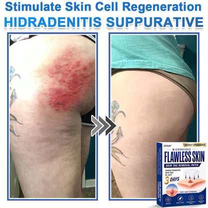🔥GFOUK® 2026 Newly Upgraded 2-in-1 Microneedle Hydrocolloid Patches | Removes Raised Moles, Acne, Flat Warts, and Skin Tags | Improves Wrinkles, Scars, and Blemishes | Invisible Acne Patches for Face & Body