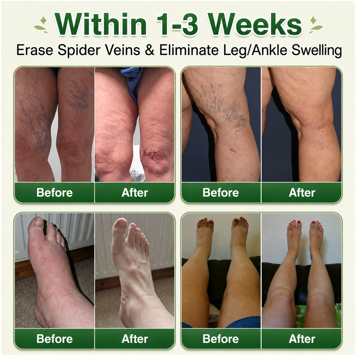 🇬🇧👨‍⚕️GFOUK® 7-in-1 Microneedle Vein & Lipedema Treatment Patch | Non-Surgical Alternative for Varicose Bulges, Spider Veins & Chronic Leg Swelling | Expert Approved