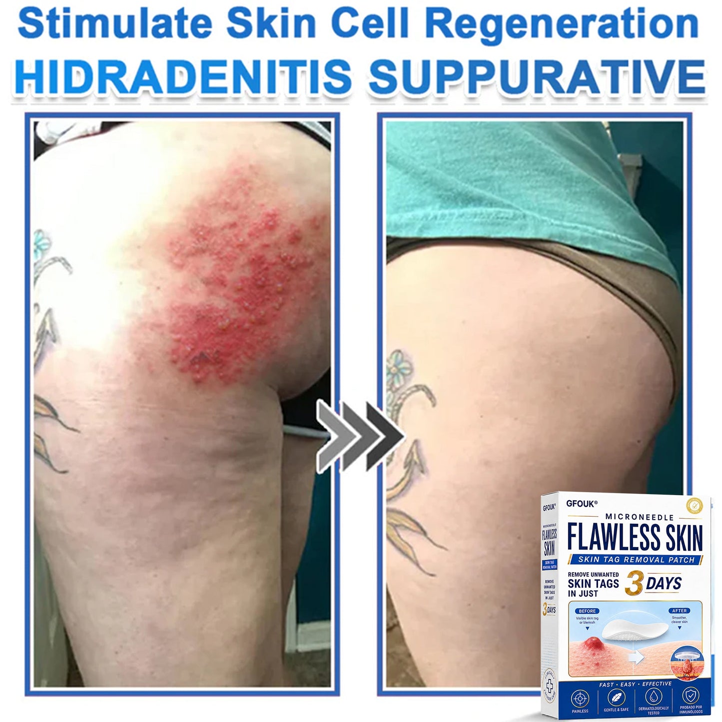✨GFOUK® 2026 Newly Upgraded 2-in-1 Microneedle Hydrocolloid Patches | Removes Raised Moles, Acne, Flat Warts, and Skin Tags | Improves Wrinkles, Scars, and Blemishes | Invisible Acne Patches for Face & Body