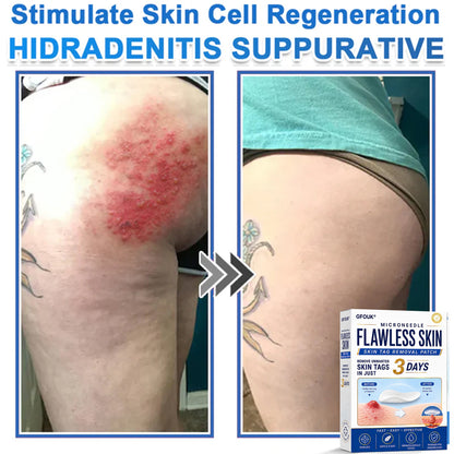 ✨GFOUK® 2026 Newly Upgraded 2-in-1 Microneedle Hydrocolloid Patches | Removes Raised Moles, Acne, Flat Warts, and Skin Tags | Improves Wrinkles, Scars, and Blemishes | Invisible Acne Patches for Face & Body