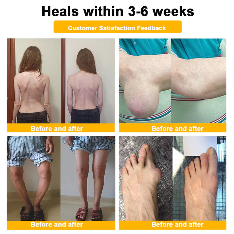 🌟Official Shop:Rolimey® Bee Venom Pain Relief Bone Healing Cream 👨‍⚕️(Reduction of joint swelling, pain, stiffness, redness, heat, muscle soreness and joint fatigue)