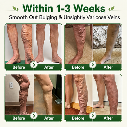 🇬🇧👨‍⚕️GFOUK® 7-in-1 Microneedle Vein & Lipedema Treatment Patch | Non-Surgical Alternative for Varicose Bulges, Spider Veins & Chronic Leg Swelling | Expert Approved
