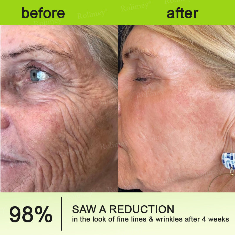 🍈Made and shipped from the UK 💫Rolimey® Botox & Vita-A Retinol Shot Wrinkle-Lift Tightening cream - Last Day Promotion 70% OFF