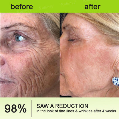 🍈Made and shipped from the UK 💫Rolimey® Botox & Vita-A Retinol Shot Wrinkle-Lift Tightening cream - Last Day Promotion 70% OFF