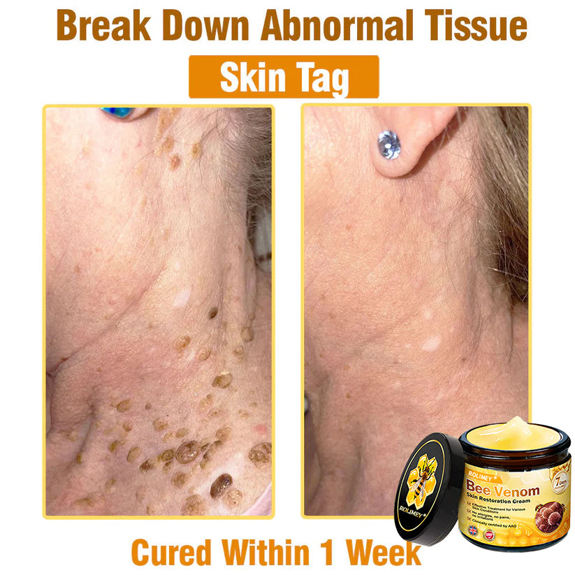 🥇FDA Approved: Rolimey® Bee Venom Skin Restoration Cream — 🔥Limited Time 80% OFF🔥