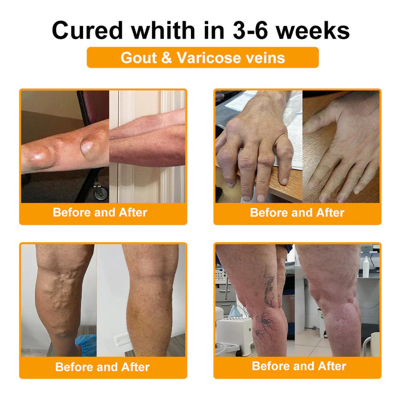 🌟Official Shop:Rolimey® Bee Venom Pain Relief Bone Healing Cream 👨‍⚕️(Reduction of joint swelling, pain, stiffness, redness, heat, muscle soreness and joint fatigue)