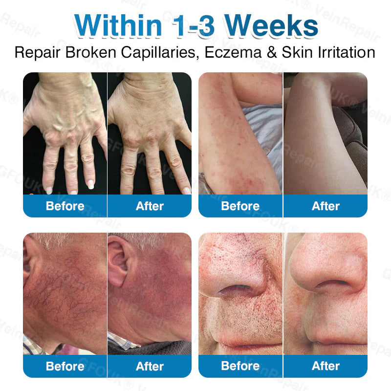 🇬🇧👨‍⚕️⬆️GFOUK® 7-in-1 Pure Natural Vein Repair Patch⚡Instant Relief, Long-Term Results-100% Hormone-Free & Botanical Power