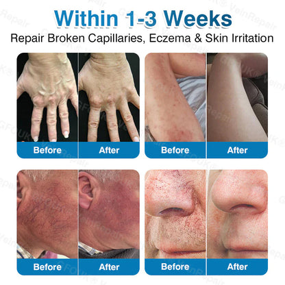 🇬🇧👨‍⚕️⬆️GFOUK® 7-in-1 Pure Natural Vein Repair Patch⚡Instant Relief, Long-Term Results-100% Hormone-Free & Botanical Power
