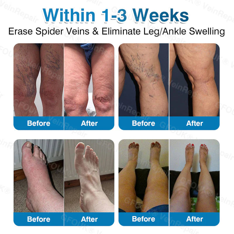 🇬🇧👨‍⚕️⬆️GFOUK® 7-in-1 Pure Natural Vein Repair Patch⚡Instant Relief, Long-Term Results-100% Hormone-Free & Botanical Power