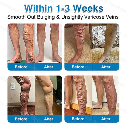 🇬🇧👨‍⚕️⬆️GFOUK® 7-in-1 Pure Natural Vein Repair Patch⚡Instant Relief, Long-Term Results-100% Hormone-Free & Botanical Power