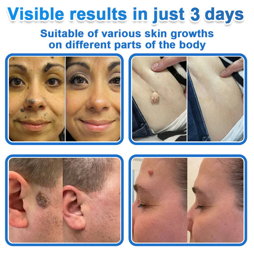 ✨GFOUK® 2026 Newly Upgraded 2-in-1 Microneedle Hydrocolloid Patches | Removes Raised Moles, Acne, Flat Warts, and Skin Tags | Improves Wrinkles, Scars, and Blemishes | Invisible Acne Patches for Face & Body