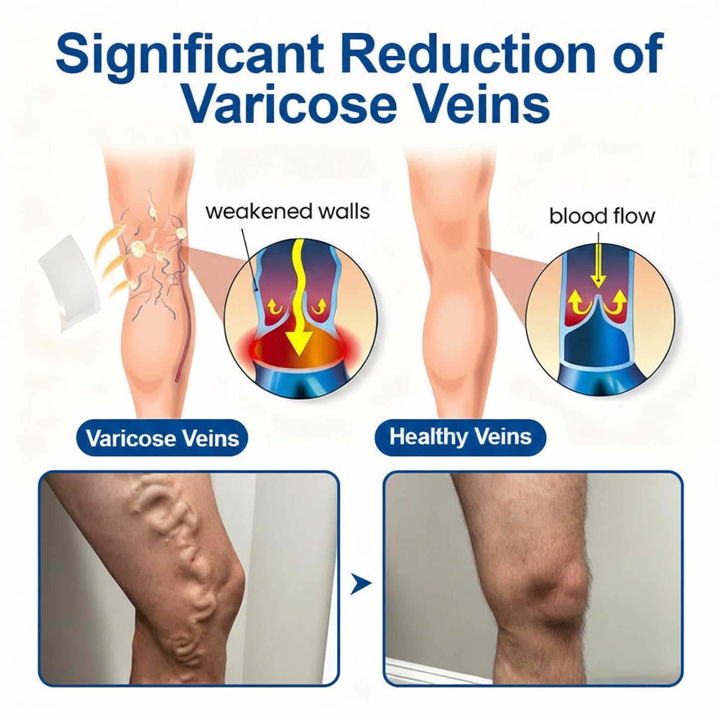 🇬🇧🌟👨‍⚕️GFOUK® VeinEase Microneedle Care Patch⚡Instant Relief, Long-Term Results
