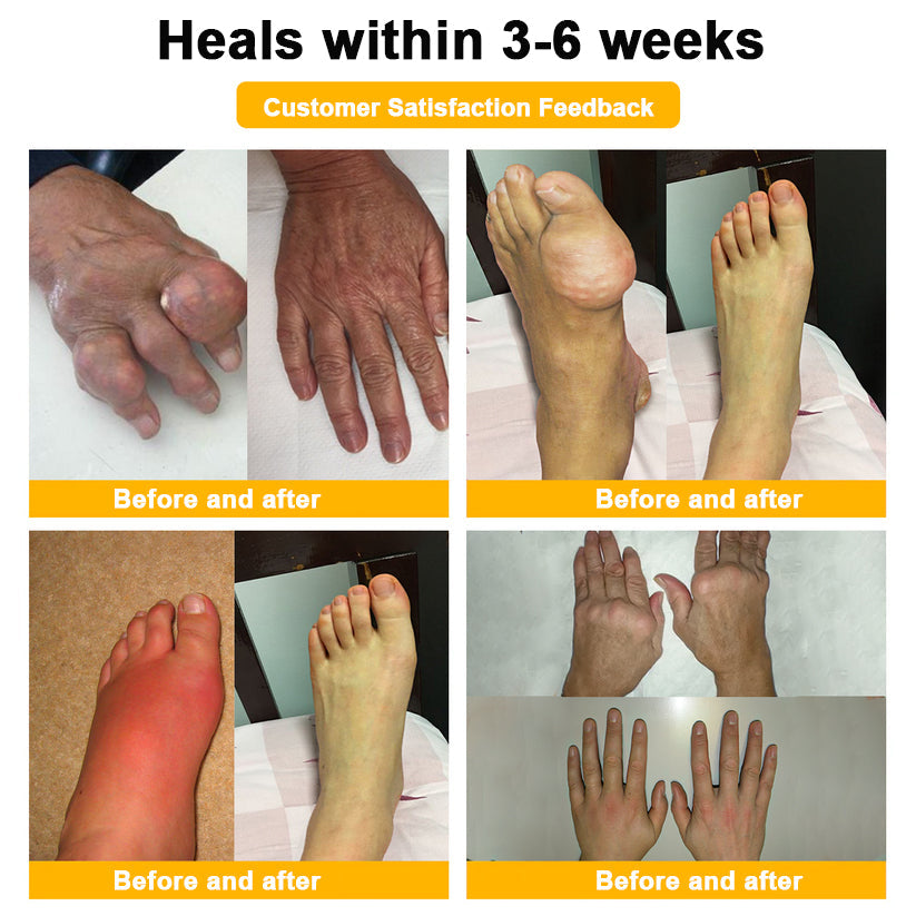 🌟Official Shop:Rolimey® Bee Venom Pain Relief Bone Healing Cream 👨‍⚕️(Reduction of joint swelling, pain, stiffness, redness, heat, muscle soreness and joint fatigue)