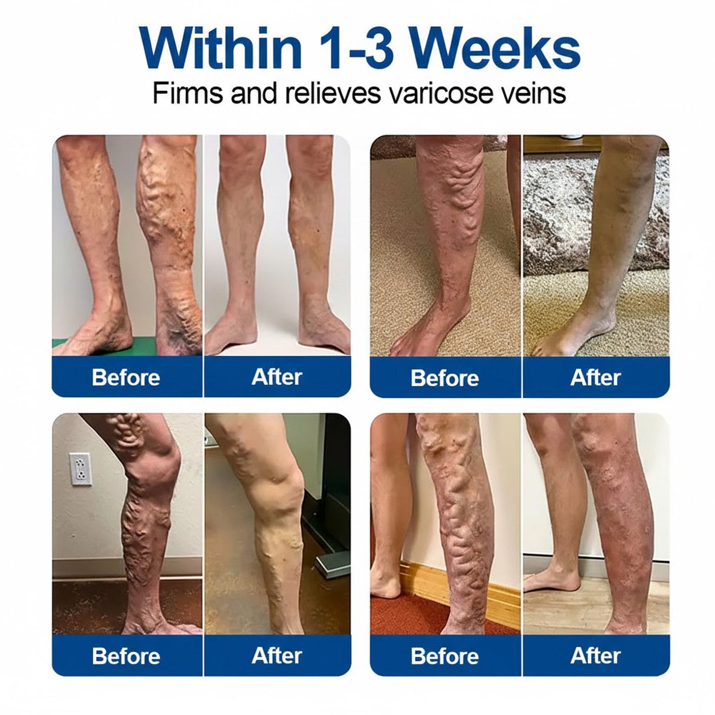 🇬🇧🌟👨‍⚕️GFOUK® VeinEase Microneedle Care Patch⚡Instant Relief, Long-Term Results