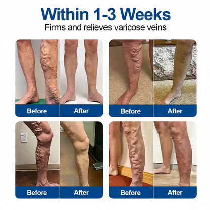 🇬🇧🌟👨‍⚕️GFOUK® VeinEase Microneedle Care Patch⚡Instant Relief, Long-Term Results