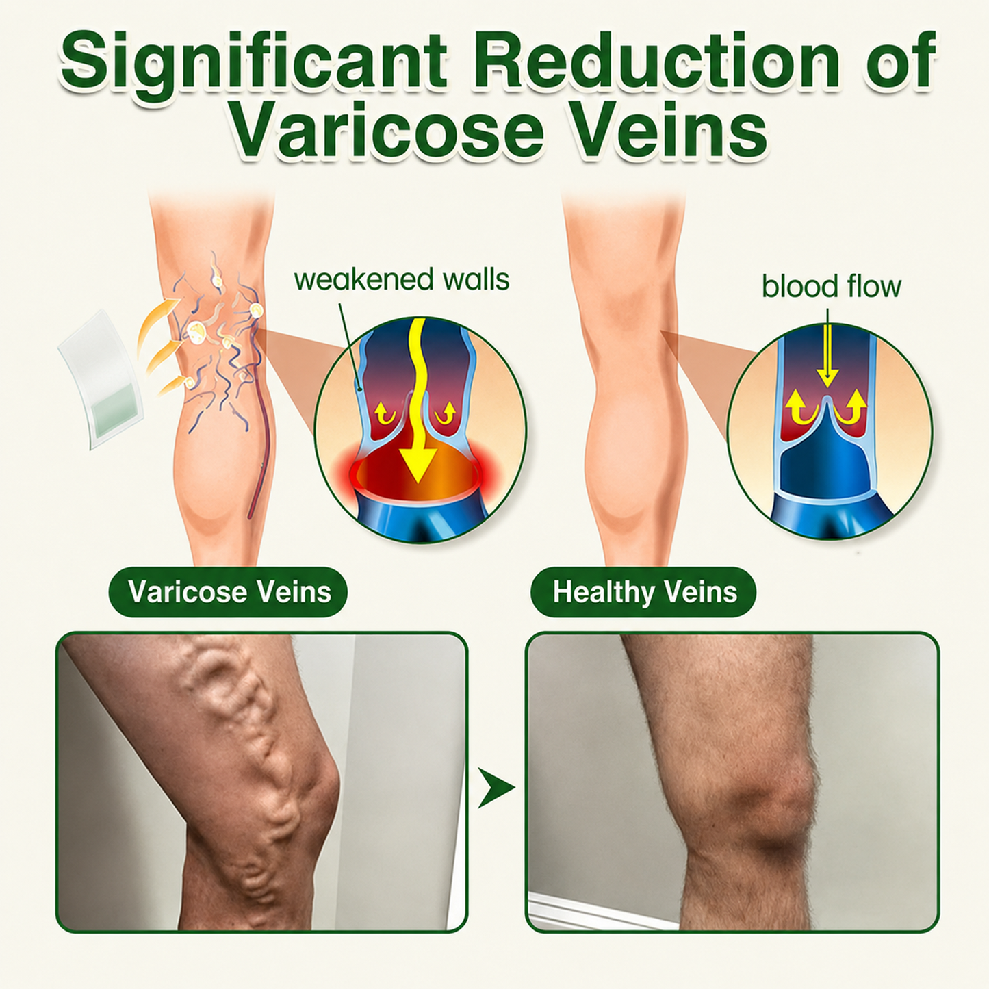 🇬🇧👨‍⚕️GFOUK® 7-in-1 Microneedle Vein & Lipedema Treatment Patch | Non-Surgical Alternative for Varicose Bulges, Spider Veins & Chronic Leg Swelling | Expert Approved