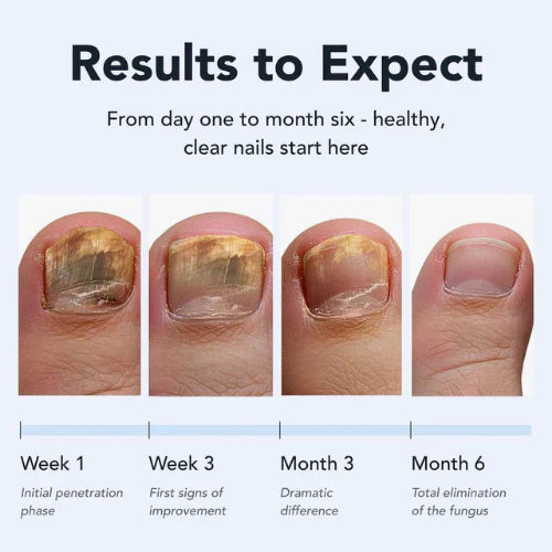 🔥🇬🇧𝑶𝒇𝒇𝒊𝒄𝒊𝒂𝒍 𝑺𝒕𝒐𝒓𝒆  |🧑‍⚕️Final 3 hours 70% off: GFOUK® Antifungal Pen -Restores nail health, repairs damage, and combats fungal infections for smooth, clear nails.