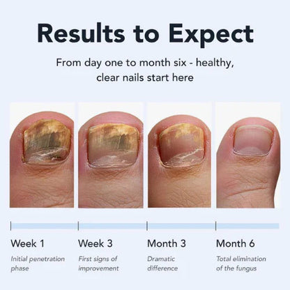 🔥🇬🇧𝑶𝒇𝒇𝒊𝒄𝒊𝒂𝒍 𝑺𝒕𝒐𝒓𝒆  |🧑‍⚕️Final 3 hours 70% off: GFOUK® Antifungal Pen -Restores nail health, repairs damage, and combats fungal infections for smooth, clear nails.
