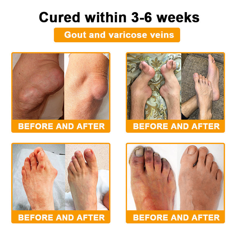 🌟Official Shop:Rolimey® Bee Venom Pain Relief Bone Healing Cream 👨‍⚕️(Reduction of joint swelling, pain, stiffness, redness, heat, muscle soreness and joint fatigue)
