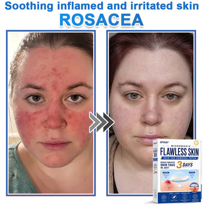 ✨GFOUK® 2026 Newly Upgraded 2-in-1 Microneedle Hydrocolloid Patches | Removes Raised Moles, Acne, Flat Warts, and Skin Tags | Improves Wrinkles, Scars, and Blemishes | Invisible Acne Patches for Face & Body