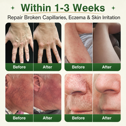 🇬🇧👨‍⚕️GFOUK® 7-in-1 Microneedle Vein & Lipedema Treatment Patch | Non-Surgical Alternative for Varicose Bulges, Spider Veins & Chronic Leg Swelling | Expert Approved
