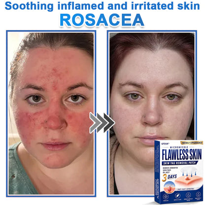 🔥GFOUK® 2026 Newly Upgraded 2-in-1 Microneedle Hydrocolloid Patches | Removes Raised Moles, Acne, Flat Warts, and Skin Tags | Improves Wrinkles, Scars, and Blemishes | Invisible Acne Patches for Face & Body