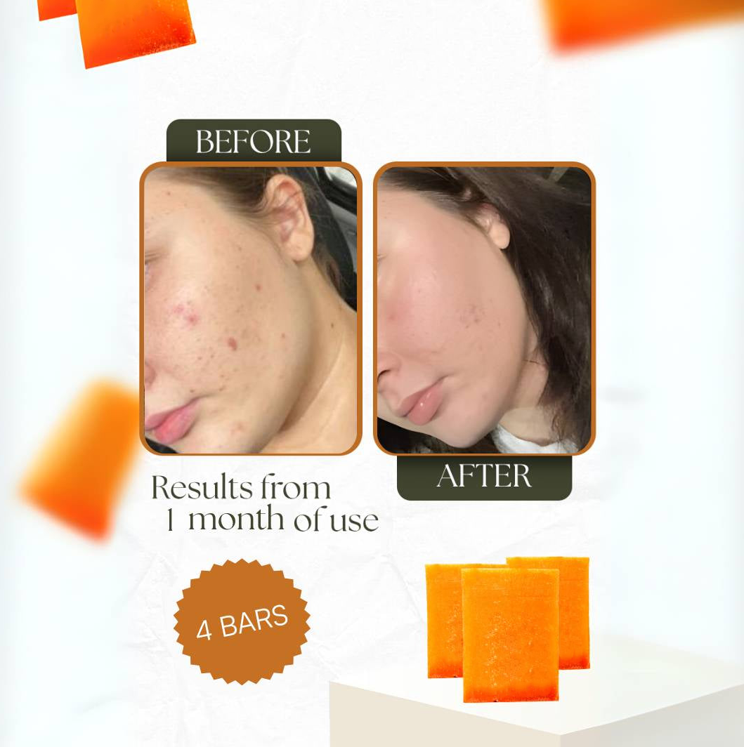 🌟 Kojic Acid Dark Spot Remover Soap Bars – Brightening Miracle 🌟 Vitamin C 🍋 + Retinol ✨ + Collagen 💖 + Turmeric 🌿 Japanese Formula 🇯🇵 | Hyaluronic Acid 💧 | Shea Butter 🧈 & Olive Oil 🫒 3 Pack