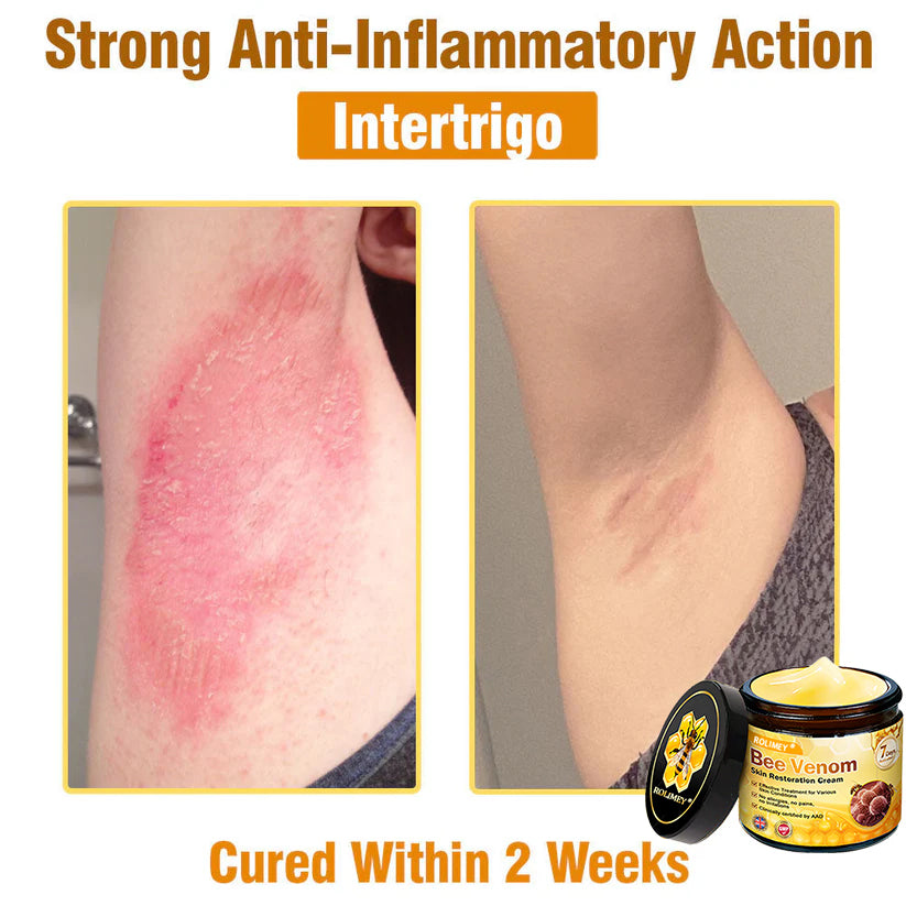 🥇FDA Approved: Rolimey® Bee Venom Skin Restoration Cream — 🔥Limited Time 80% OFF🔥