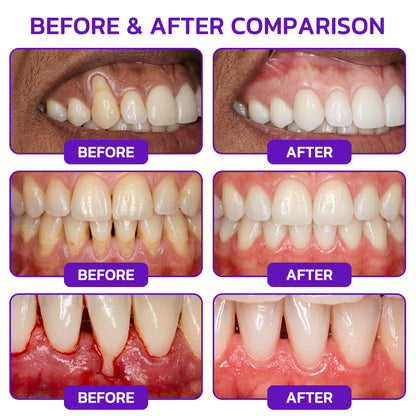 🇬🇧🧑‍⚕️🦷Evolvion® Bee Venom Gingivitis & Periodontitis Treatment Toothpaste🎁