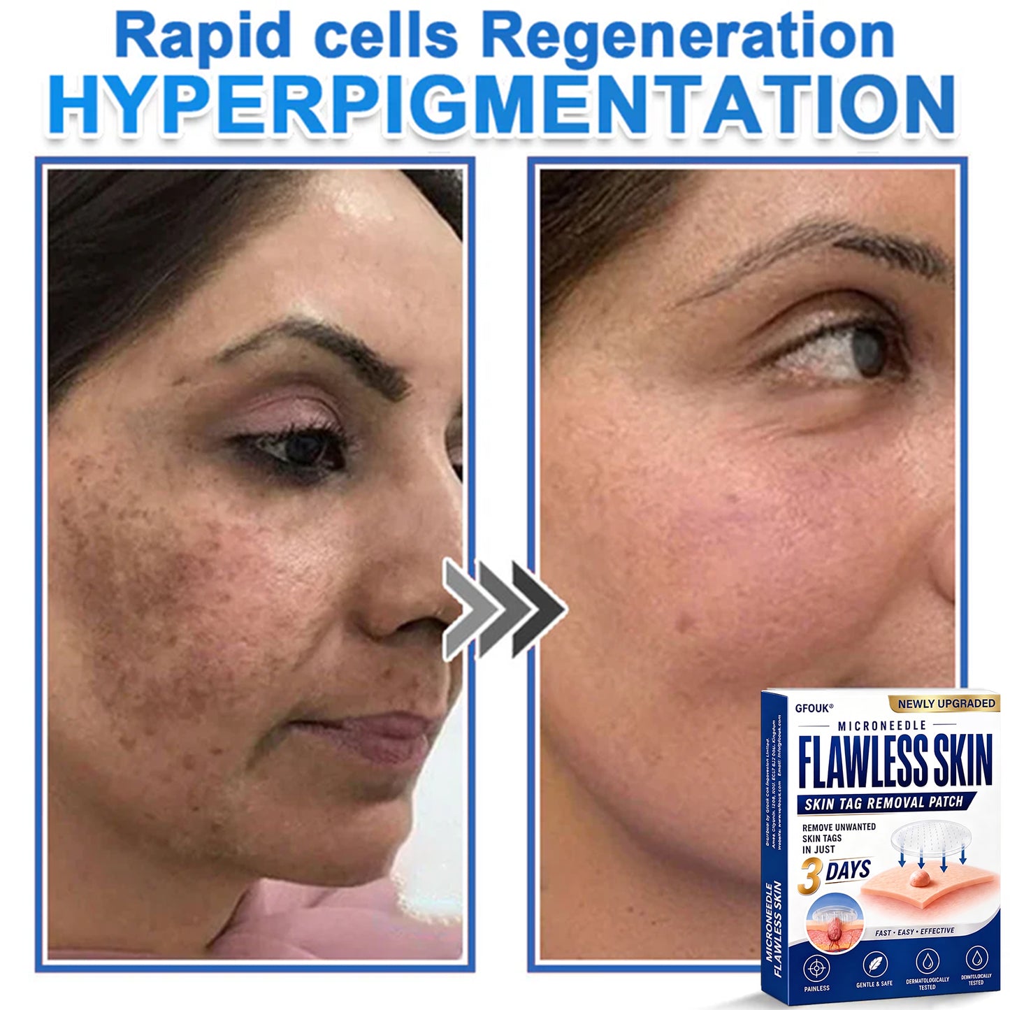 🔥GFOUK® 2026 Newly Upgraded 2-in-1 Microneedle Hydrocolloid Patches | Removes Raised Moles, Acne, Flat Warts, and Skin Tags | Improves Wrinkles, Scars, and Blemishes | Invisible Acne Patches for Face & Body