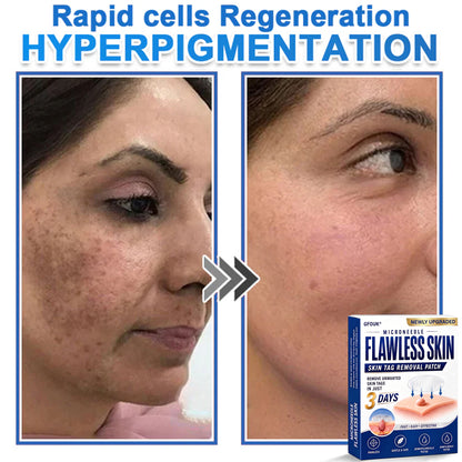 🔥GFOUK® 2026 Newly Upgraded 2-in-1 Microneedle Hydrocolloid Patches | Removes Raised Moles, Acne, Flat Warts, and Skin Tags | Improves Wrinkles, Scars, and Blemishes | Invisible Acne Patches for Face & Body
