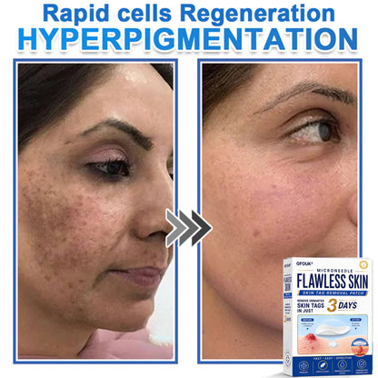 ✨GFOUK® 2026 Newly Upgraded 2-in-1 Microneedle Hydrocolloid Patches | Removes Raised Moles, Acne, Flat Warts, and Skin Tags | Improves Wrinkles, Scars, and Blemishes | Invisible Acne Patches for Face & Body