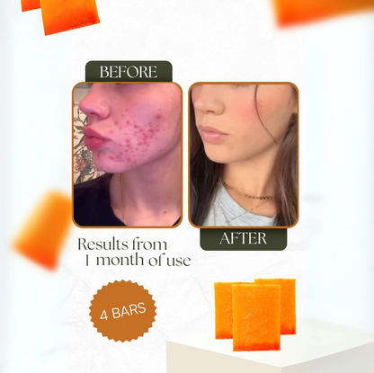 🌟 Kojic Acid Dark Spot Remover Soap Bars – Brightening Miracle 🌟 Vitamin C 🍋 + Retinol ✨ + Collagen 💖 + Turmeric 🌿 Japanese Formula 🇯🇵 | Hyaluronic Acid 💧 | Shea Butter 🧈 & Olive Oil 🫒 3 Pack