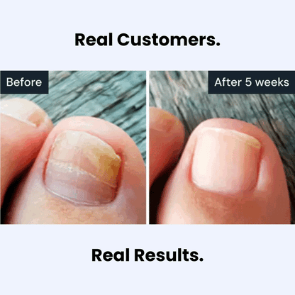 🔥🇬🇧𝑶𝒇𝒇𝒊𝒄𝒊𝒂𝒍 𝑺𝒕𝒐𝒓𝒆  |🧑‍⚕️Final 3 hours 70% off: GFOUK® Antifungal Pen -Restores nail health, repairs damage, and combats fungal infections for smooth, clear nails.