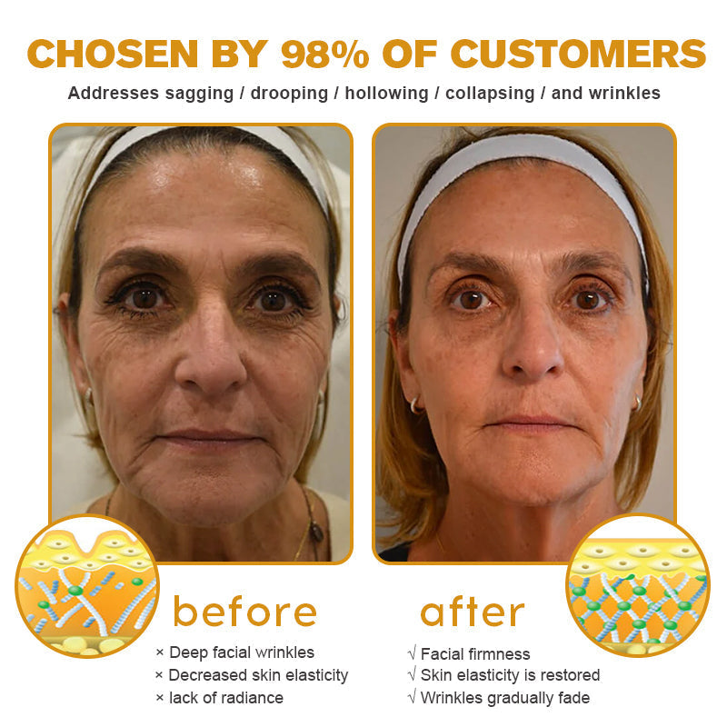 (🌟Made and Shipped from UK✅) Official Store |Furzero™ Botox Bee Venom Wrinkle Removal Cream- LAST DAY 70% OFF